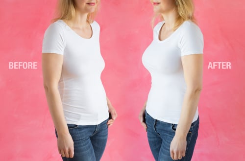 Breast Lift shutterstock_1407627671