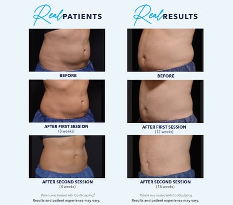 Coolsculpting Elite4