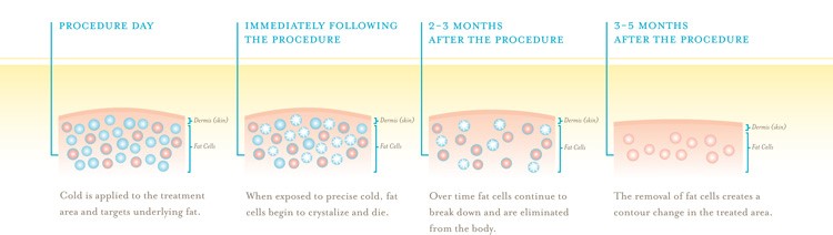 coolsculpting graphic-1