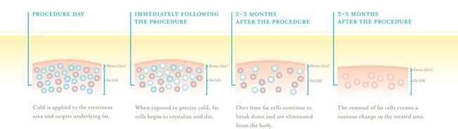 coolsculpting graphic-2