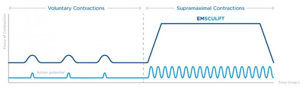 emsculpt chart-1