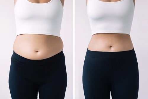 Transform Your Body: 8 Things to Know About Liposuction